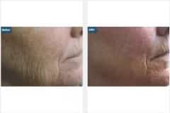 02Laser-Resurfacing