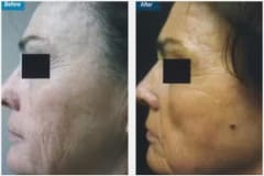 04Laser-Resurfacing