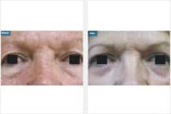 05Laser-Resurfacing