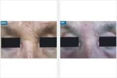 06Laser-Resurfacing