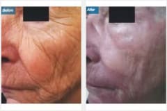 07Laser-Resurfacing