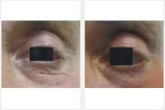 08Laser-Resurfacing