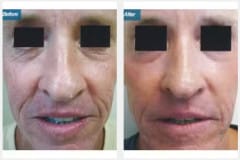 09Laser-Resurfacing