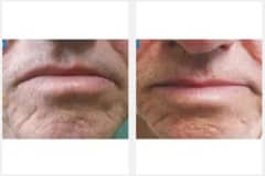 10Laser-Resurfacing