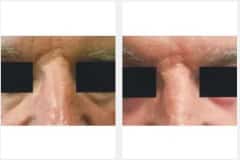 11Laser-Resurfacing