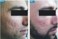 12Laser-Resurfacing
