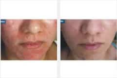 13Laser-Resurfacing