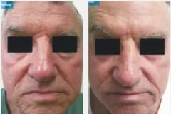 14Laser-Resurfacing