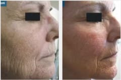 15Laser-Resurfacing