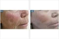 16Laser-Resurfacing