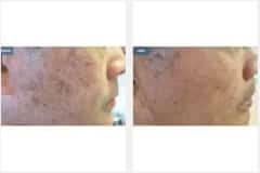 17Laser-Resurfacing