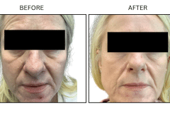 LB Lasers Laser Resurfacing Co2 Laser - Patient10