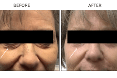 LB Lasers Laser Resurfacing Co2 Laser - Patient11