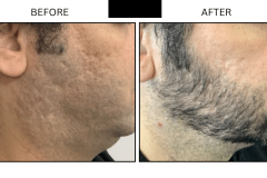 LB Lasers Laser Resurfacing Co2 Laser - Patient13