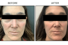 LB Lasers Laser Resurfacing Co2 Laser - Patient14