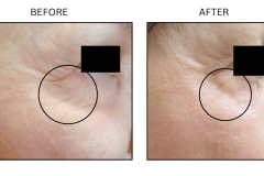LB Lasers Laser Resurfacing Co2 Laser - Patient1a