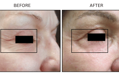 LB Lasers Laser Resurfacing Co2 Laser - Patient1b