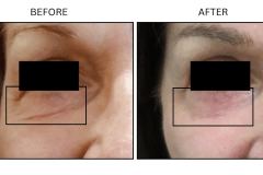 LB Lasers Laser Resurfacing Co2 Laser - Patient1c