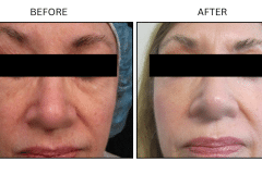 LB Lasers Laser Resurfacing Co2 Laser - Patient2a