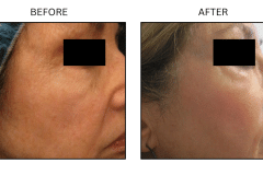 LB Lasers Laser Resurfacing Co2 Laser - Patient2b