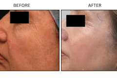 LB Lasers Laser Resurfacing Co2 Laser - Patient2c
