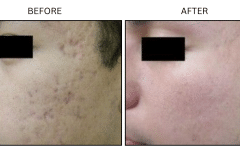 LB Lasers Laser Resurfacing Co2 Laser - Patient5