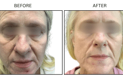 LB Lasers Laser Resurfacing Co2 Laser - Patient10