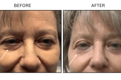 LB Lasers Laser Resurfacing Co2 Laser - Patient11