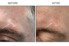 LB Lasers Laser Resurfacing Co2 Laser - Patient12