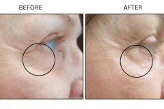 LB Lasers Laser Resurfacing Co2 Laser - Patient1a