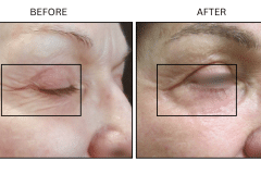 LB Lasers Laser Resurfacing Co2 Laser - Patient1b