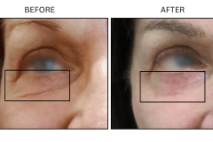 LB Lasers Laser Resurfacing Co2 Laser - Patient1c