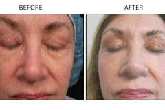LB Lasers Laser Resurfacing Co2 Laser - Patient2a