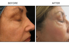LB Lasers Laser Resurfacing Co2 Laser - Patient2b