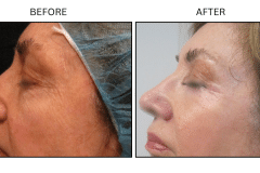 LB Lasers Laser Resurfacing Co2 Laser - Patient2c