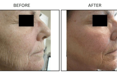 LB Lasers Laser Resurfacing Co2 Laser - Patient3