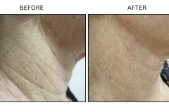 LB Lasers Laser Resurfacing Co2 Laser - Patient4