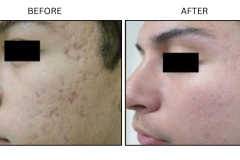 LB Lasers Laser Resurfacing Co2 Laser - Patient5