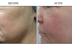 LB Lasers Laser Resurfacing Co2 Laser - Patient6a