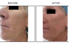 LB Lasers Laser Resurfacing Co2 Laser - Patient7a