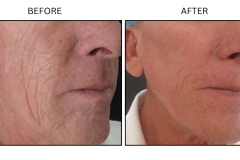 LB Lasers Laser Resurfacing Co2 Laser - Patient7b