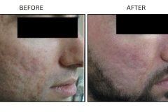 LB Lasers Laser Resurfacing Co2 Laser - Patient8