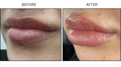 LB Fillers Lips - Patient2b