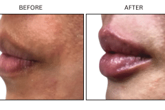LB Fillers Lips - Patient1