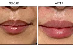 LB Fillers Lips - Patient10