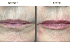 LB Fillers Lips - Patient11