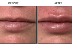 LB Fillers Lips - Patient12