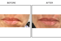 LB Fillers Lips - Patient13