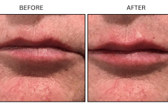 LB Fillers Lips - Patient14