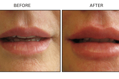 LB Fillers Lips - Patient16